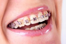 brekety-v-ortodontii-3636.jpeg